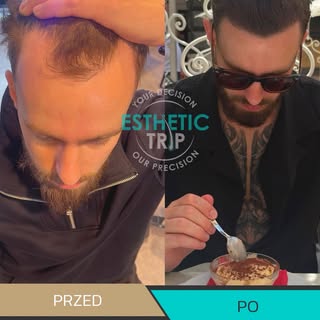 Kilka miesięcy po zabiegu, tak prezentują 
się efekty kolejnego z naszych pacjentów 😎😍

#klinika #