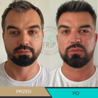 Efekty po 5 miesiącach od 
przeszczepu włosów z Esthetic Trip! ✨ 

Dobrej jakości włosy, które szybk