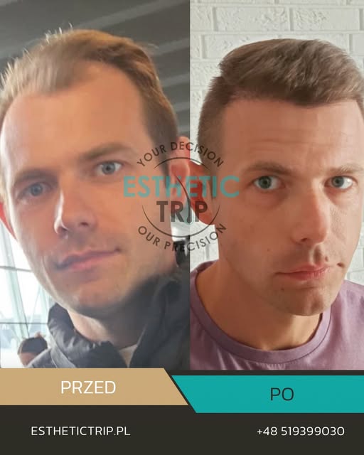 Naturalna linia włosów potrafi 
całkowicie zmienić proporcje twarzy 👌

Efekt po przeszczepie włosów