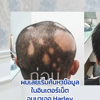 ผมร่วง💥 ไม่หาหมอแล้วไม่หาย⁉️ แต่พอมาดูแลที่ Harley St. Hair Centre แล้วเห็นผลลัพธ์ชัดเจนขึ้นเรื่อยๆ