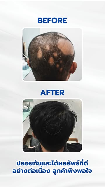ดูแลสุขภาพเส้นผมและใหม่แบบเฉพาะบุคคลได้ที่ Harley St. Hair Centre✨

🔹ผมหนา แข็งแรง
🔹ปลอดภัยกว่า
*ผ