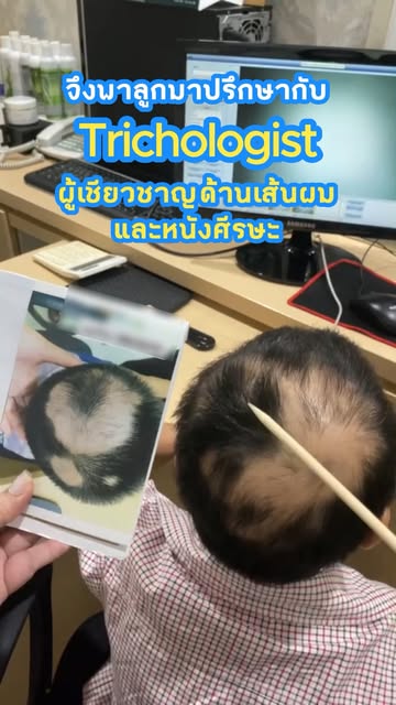 รีวิวการดูแล #เด็ก ที่เป็น #ผมร่วงเป็นหย่อม หลังจากเคยไปรักษากับหมอแล้วไม่ดีขึ้น⁉️

ที่ 📍 Harley St
