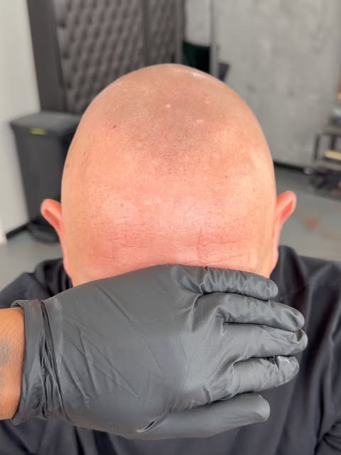 9 months healed SMP….. very very subtle and undetectable, super soft hairline just as the client req