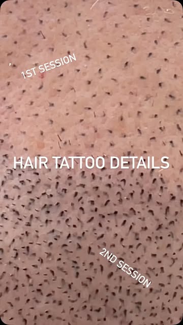 Check out this video mid 2nd session. You’ll see the healed impressions from the 1st session (retent