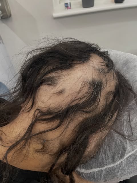 Alopecia Areata & SMP

Alopecia areata is an autoimmune condition where the immune system mistakenly