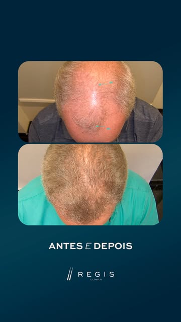 Para alguns isso é só um antes e um depois, mas quem passou pelo transplante capilar sabe que a muda
