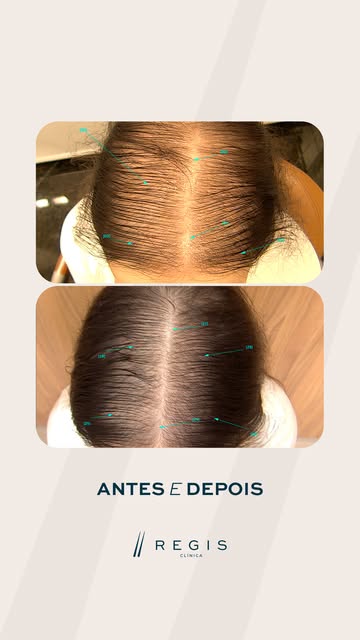 Tem mulheres que passam anos lidando com o cabelo que dia após dia afina e perde volume, muitas veze