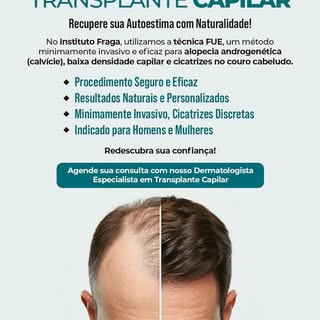 Transplante Capilar: uma solução eficaz para quem enfrenta alopecia androgenética (calvície), baixa 