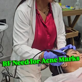 Fading acne marks… Revealing fresh skin #microneedling #acnetreatment #acnescars #acnemarks #freshsk