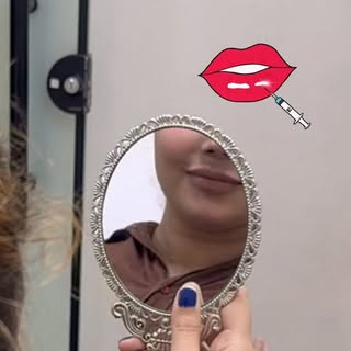 Beautifully balanced lips #lipfiller #barbielips #natural #patientsatisfaction #lipenhancement