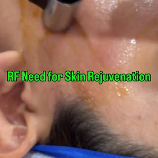 ✨ Renew. Rejuvenate. Glow. ✨ #microneedling #glow #healthyskin #skincare