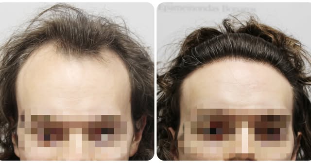 Witness the extraordinary transformation of our patient, whose confidence has greatly increased afte