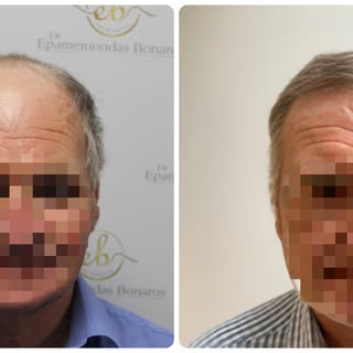 This patient came to Dr Bonaros’ clinic with advanced hair loss and a clear goal to restore his hair