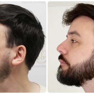 This gentleman came to Dr Bonaros’ clinic seeking a fuller, more defined beard after years of feelin