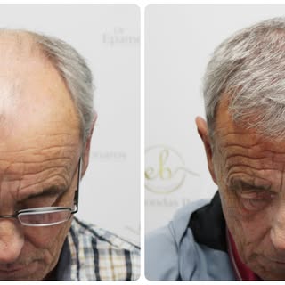 Full-scalp restoration, delivered with a truly natural finish. 

This patient underwent two hair tra