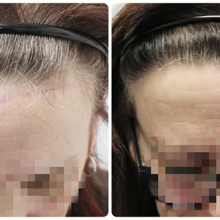 Soft, natural hairline restoration for her frontal area and temples, designed to add density while k