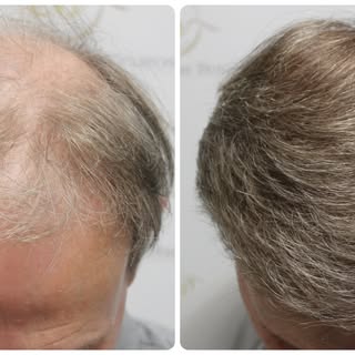 An incredible, natural-looking transformation after two hair transplant procedures at Dr Bonaros Cli