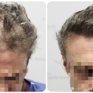 At Dr Bonaros Clinic, we use an unshaven FUE technique to transplant hair discreetly. For maximum pr