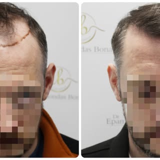 This patient underwent a hair transplant at Dr Bonaros Clinic with results so refined and undetectab