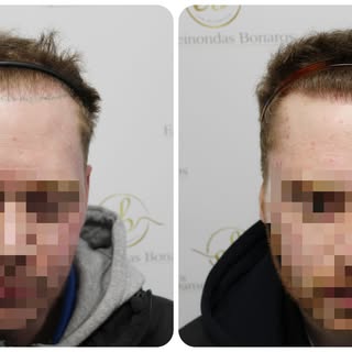 A refined transformation following a previous hair transplant that had left the patient disappointed