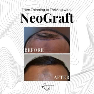 What a transformation! ✨ From thinning to thriving—our hair restoration treatments deliver real resu