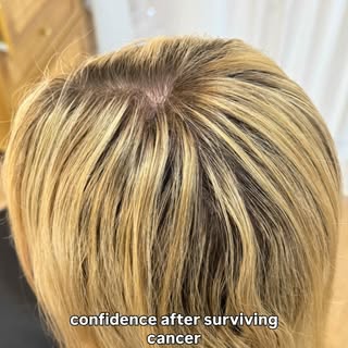 The Power of Bespoke Hair Restoration 🤍

Two scalp surgeries to remove melanoma skin cancer left my