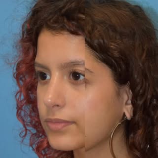 A good rhinoplasty should be subtle and harmonious to your face ✨ #facialplasticsurgeon #rhinoplasty