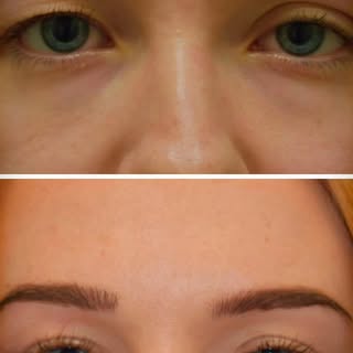 Do people ask if you are tired? It may be that you have hooded eyelids. This one-hour in-office proc
