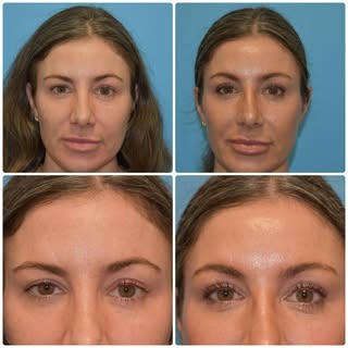 Brow asymmetry is a common issue for many patients, and it is relatively easy fix. In this patient, 