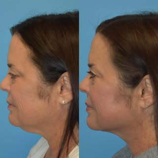 Some patients have a significant skin laxity especially at the center portion of their neck. An In o