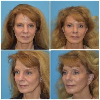 A lot of patients are afraid of looking overdone after a lifting procedure. This is completely avoid