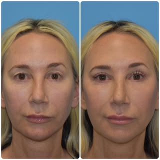 In-office upper blepharoplasty + mini-lift is a great combination surgery for those patients with ea