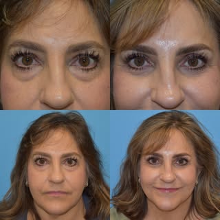 Blepharoplasty is a surgical procedure that addresses excess skin and fat around the eyes, which com
