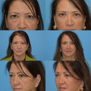 This patient’s periorbital (eye region) appearance makes her look tired. A conservative #templetuck 