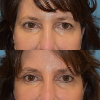 Lateral hooding and excess upper lid skin improved by #endoscopic temporal lift and #upper blepharop