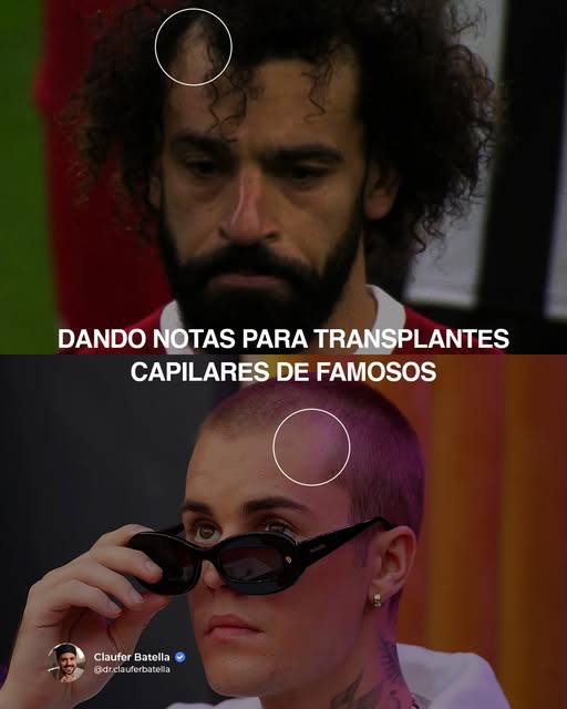 Estamos em 2026… e ainda tem gente julgando transplante capilar só pelo “antes e depois” 👀

Dar not