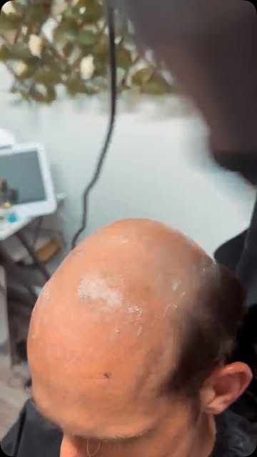 Hair loss is so much more than just physical—it can quietly take away a piece of your confidence, yo