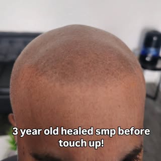 Client came in for a touch up after 3 years since getting smp done with us. 

www.luxemicro.com.au
0