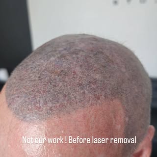 Client came to us for a touch up having previously done smp elsewhere and it turned into a laser rem