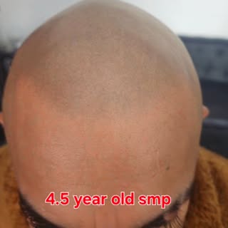 Client came back for a touch up after 4.5 years since getting it done by us. Healed results and stil
