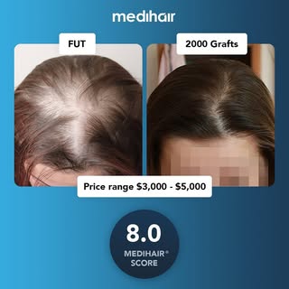 This case scored an 8.0 on our Medihair scale of rating for hair transplants. The Medihair scores ta