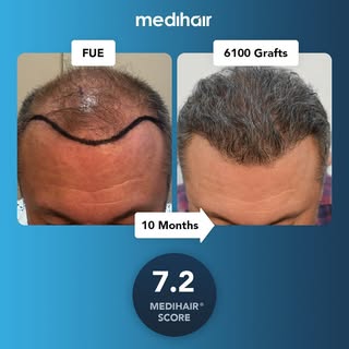 This case scored a 7.2 on our Medihair scale of rating for hair transplants. The Medihair scores tak