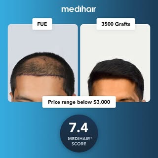 This case scored a 7.4 on our Medihair scale of rating for hair transplants. The Medihair scores 
t
