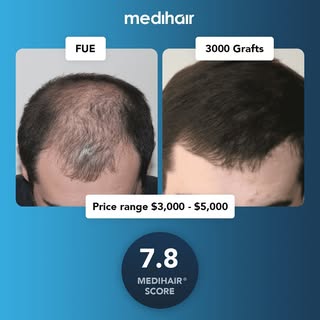 This case scored a 7.8 on our Medihair scale of rating for hair transplants. The Medihair scores 
t