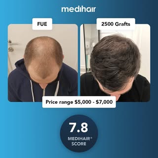 This case scored a 7.8 on our Medihair scale of rating for hair transplants. The Medihair scores 
t