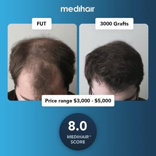This case scored an 8.0 on our Medihair scale of rating for hair transplants. The Medihair scores 
