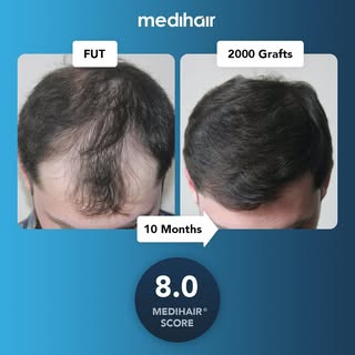 This case scored an 8.0 on our Medihair scale of rating for hair transplants. The Medihair scores 
