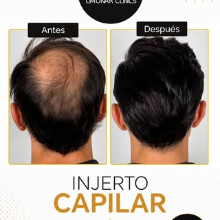 Un injerto capilar puede marcar una gran diferencia en la densidad y apariencia del cabello. ✨

Cada