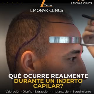 El PRP capilar utiliza factores de crecimiento presentes en tu propia sangre para favorecer la salud