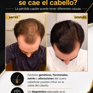 La caída del cabello no siempre tiene una única causa.

La genética, los cambios hormonales, el estr